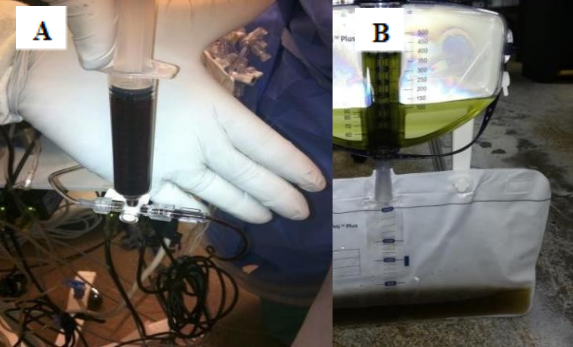 Coloración de sangre y orina en paciente con metahemoglobina