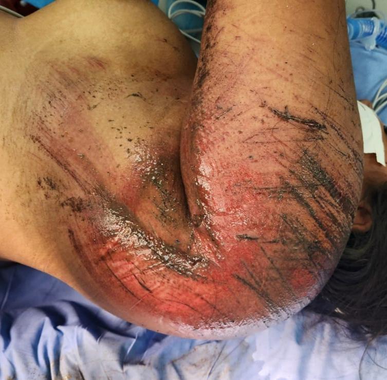 Abrasión hombro izquierdo